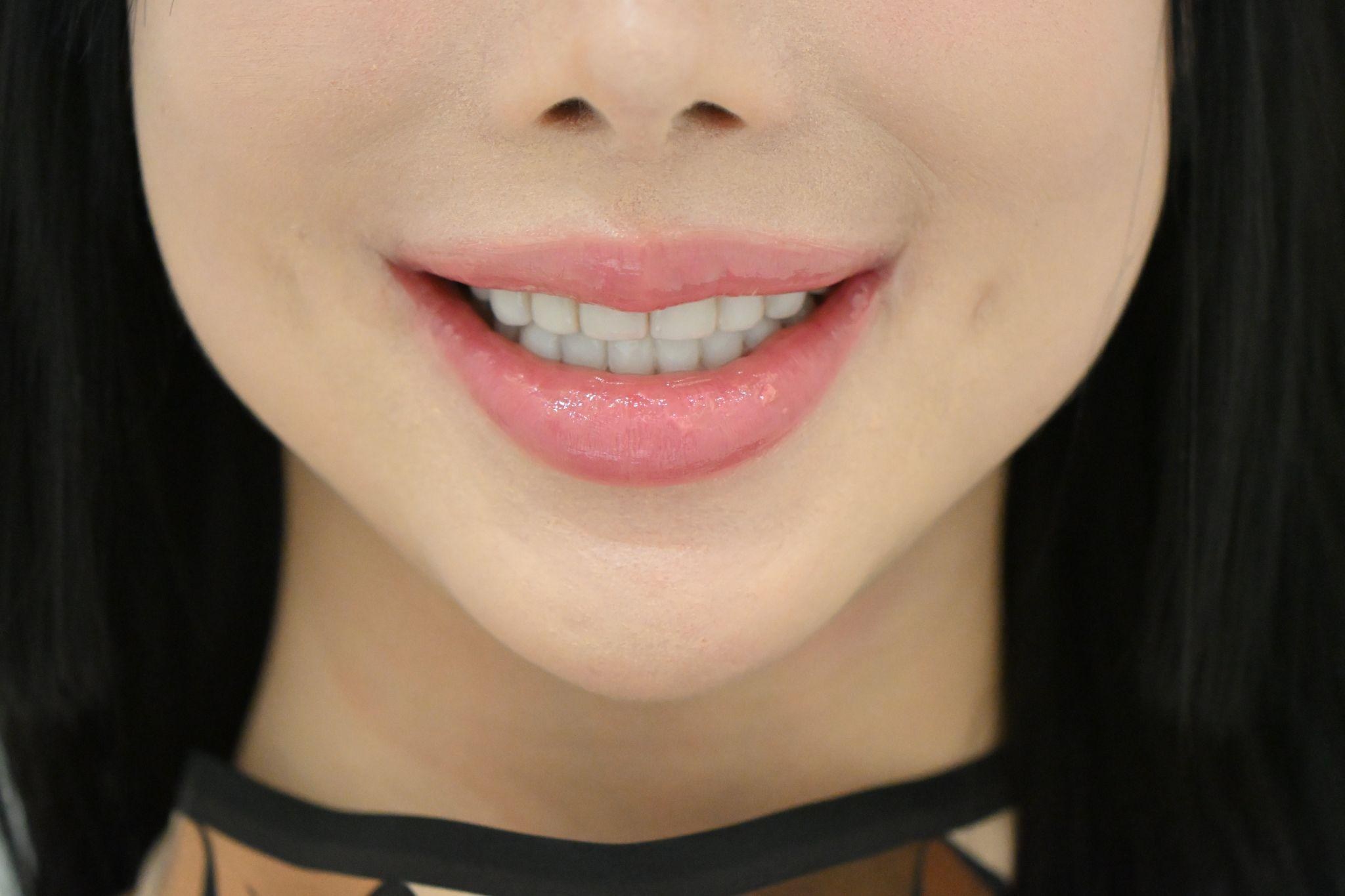 아래 앞니