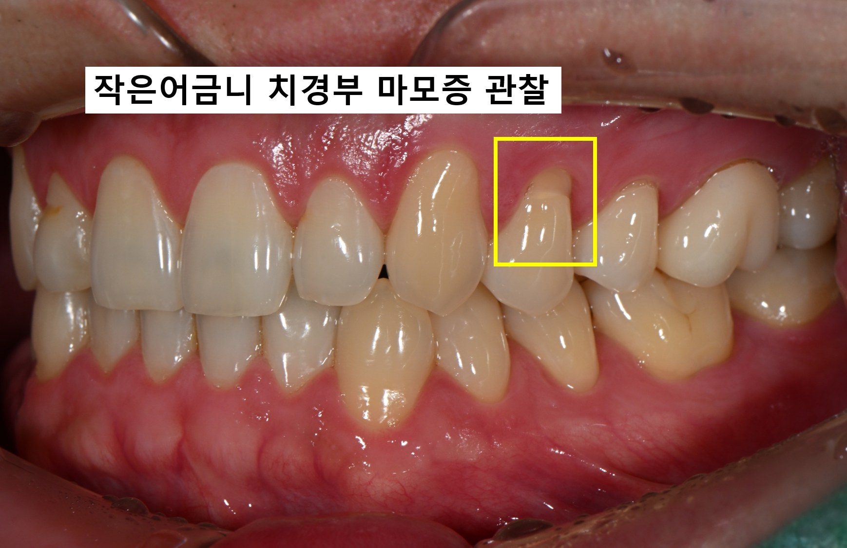 치경부 홈