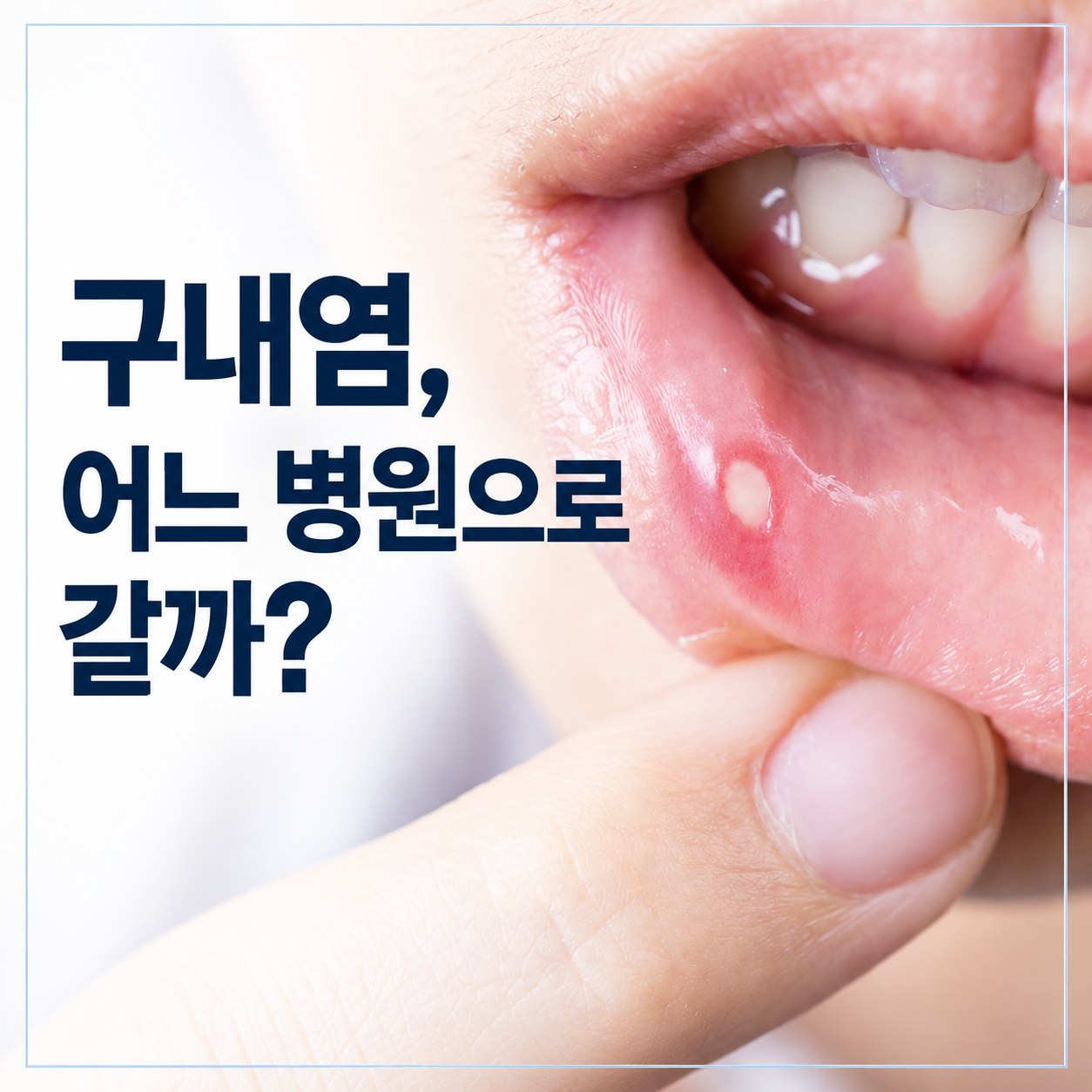 입안 궤양